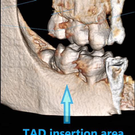 Frontal cross-section of mandibular buccal shelf illustrating axial ...