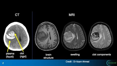 Mri Vs Ct Scan Brain Stroke Ct Scan Machine | Free Nude Porn Photos