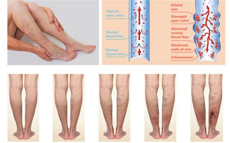 A Closer Look at Chronic Venous Insufficiency: Understanding Symptoms ...