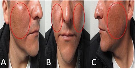 Doxycycline Induced Hyperpigmentation without Sun Exposed — Donovan ...