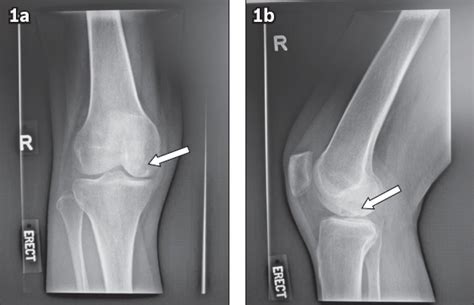 Knee subchondroplasty for management of subchondral bone cysts: a novel ...