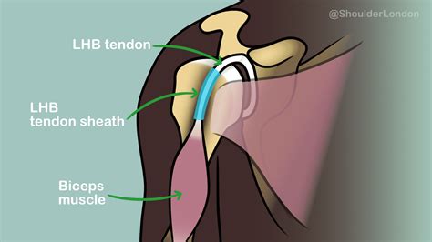 Long Head of Biceps (LHB) Tendon Problems - Nick Ferran