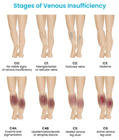 What are the 8 stages of the CEAP classification of venous ...