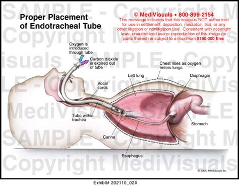 Medivisuals Proper Placement of Endotracheal Tube Medical Illustration