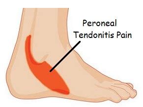 Pain On Outside Of Foot: Causes & Treatment Of Lateral Foot Pain