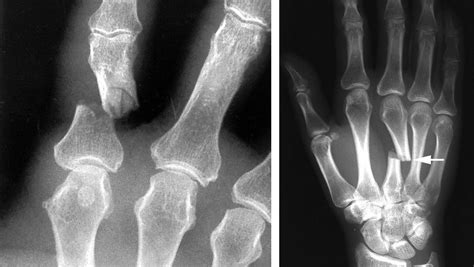 Hand Fractures - OrthoInfo - AAOS