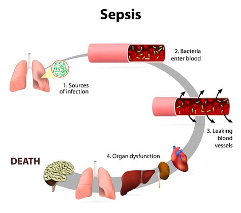 Circulating Biomarkers in Critical Illness and Sepsis | BioVendor R&D