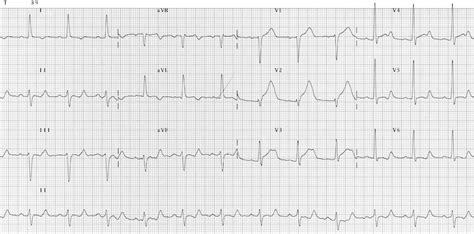 QT Interval • LITFL • ECG Library Basics