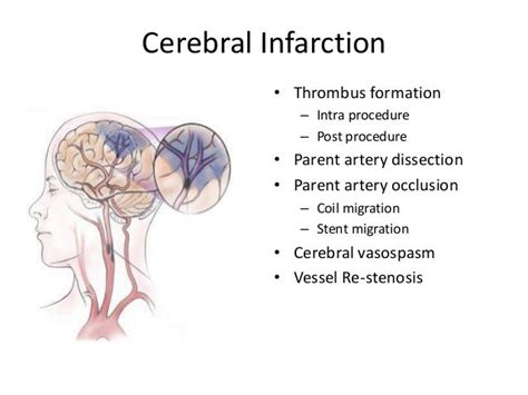 Endovascular treatment in acute cerebral ischemia