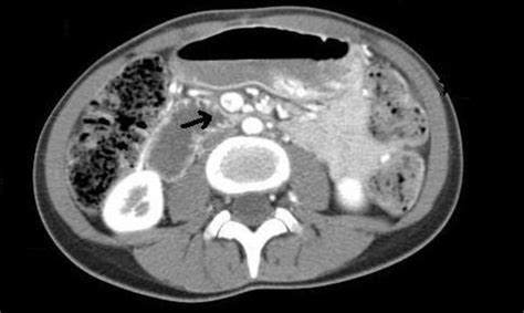 Ct Scan Of The Abdomen And Pelvis With And Without Contrast | Hot Sex ...