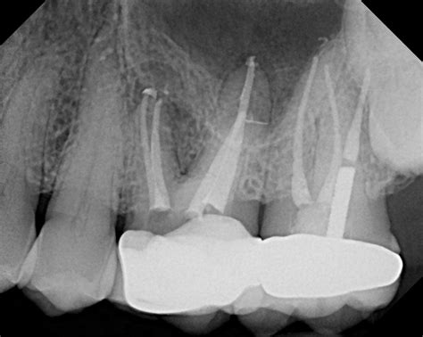 The Endo Blog: Persistent Post-Treatment (Apical) Periodontitis.