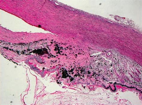 Neovascular Glaucoma | Ento Key