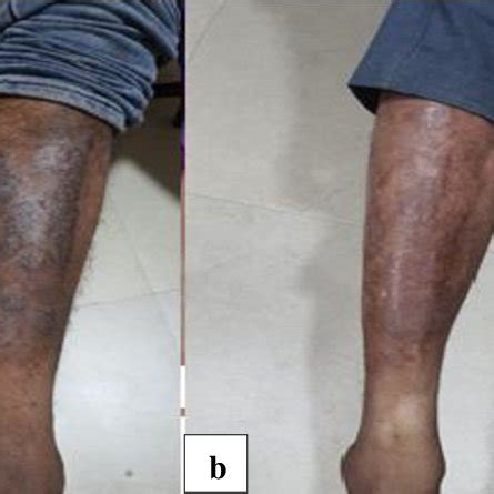 (a) Pretreatment image of crusty and scaly lesion around the inner ...