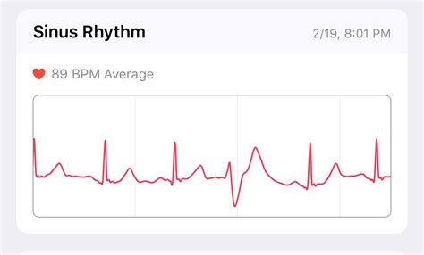 The Apple Watch's ECG Helped My Wife - JSWordSmith.com