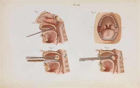 Plate 46, The removal of nasal polyps and tonsillectomy. | Wellcome ...