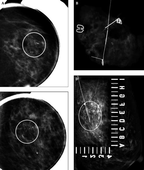 A 69-year-old woman with abnormal left mammogram categorized as 4c. A ...