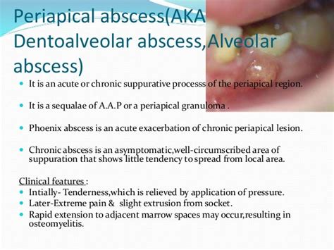 Apical Periodontitis Vs Apical Abscess