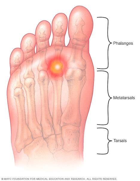 Top Of Foot Pain Running - All You Need Infos