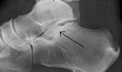 Subtalar Osteoarthritis - Cause, Symptoms, Treatment, Exercise