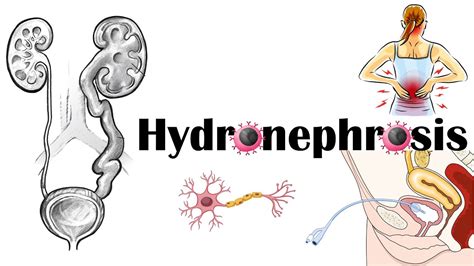 Hydronephrosis - Definition, Functional Anatomy, Causes, Signs ...