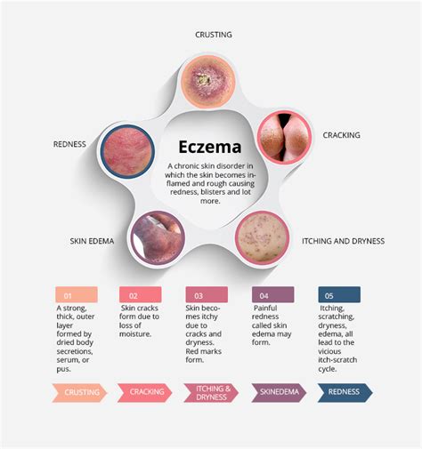 Interesting Facts about Atopic Dermatitis - Eczema Infographic