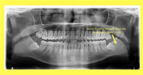 Chance Of Nerve Damage Wisdom Teeth - Teeth Poster