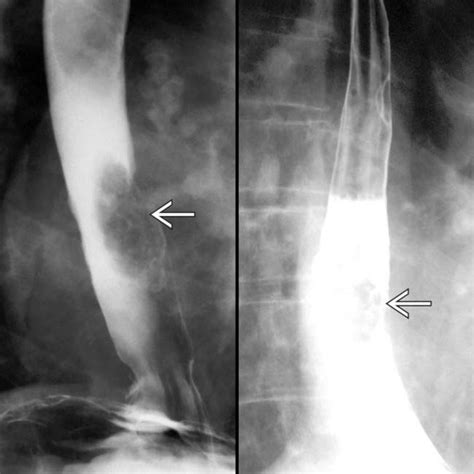 Barrett Esophagus | Clinical Gate