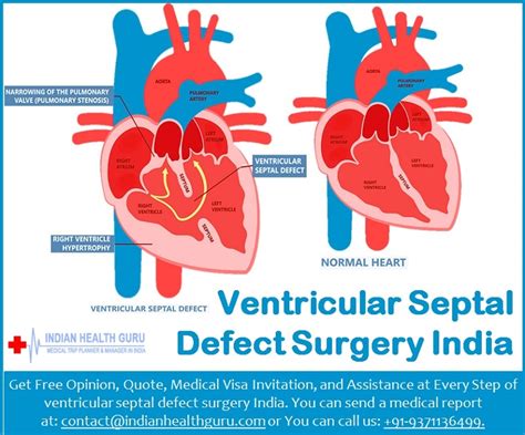 Ventricular Septal Defect Surgery Cost In India - Health - Nigeria