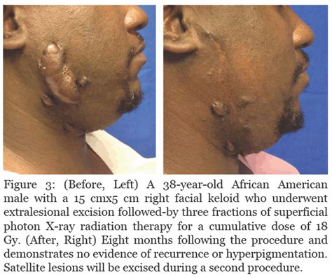 Keloid Treatment