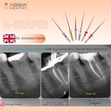 LL7:Irreversible Pulpitis With Symptomatic Apical Periodontitis ...