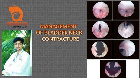 MANAGEMENT OF BLADDER NECK CONTRACTURE - YouTube