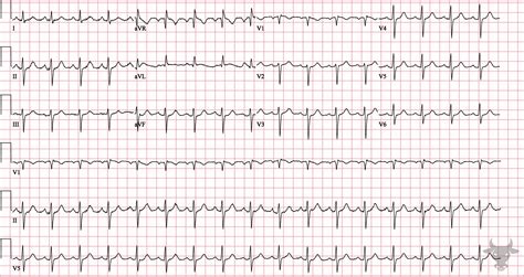 Left Anterior Fascicular Block | ECG Stampede