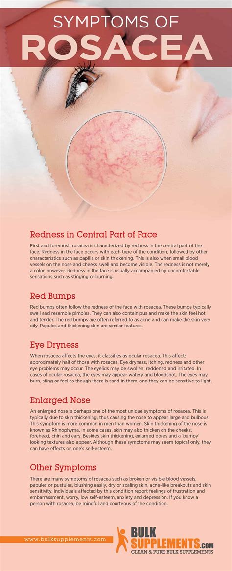 Rosacea: Symptoms, Causes & Treatment