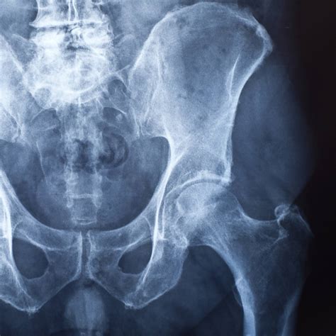 Hip Osteoarthritis | Orthopedics