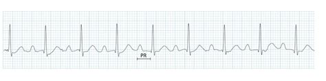 First Degree Heart Block • LITFL • ECG Library Diagnosis