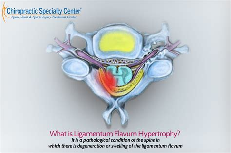 Ligamentum Flavum Hypertrophy | Definition, Cause And Treatment