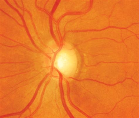 Cup-to-Disc Ratio Associated with Optic Nerve, Brain Aging