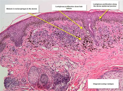 melanoma histology - pictures, photos