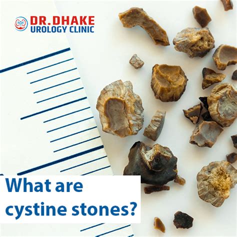 Cystine Kidney Stones