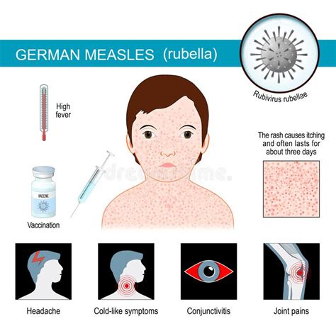 German Measles. Infographics about Symptoms of Rubella Stock Vector ...