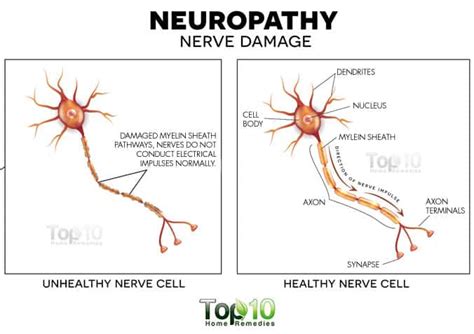 Nerve Damage: Causes, Symptoms, and Complications | Top 10 Home Remedies