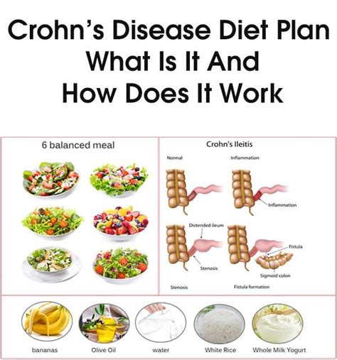 Crohn’s Disease Diet Plan – What Is It And How Does It Work?