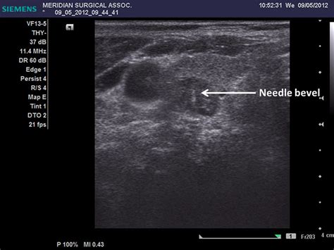 Malignant: Malignant Thyroid Nodules