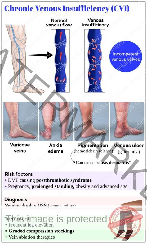 Chronic venous insufficiency (CVI) - Medicine Keys for MRCPs