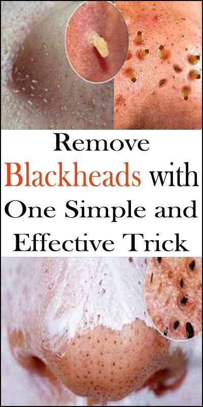 Remove Blackheads With One Simple And Effective Trick | Remedies Well