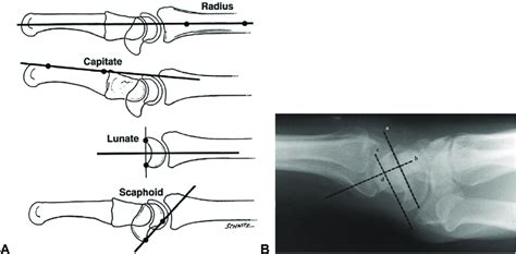 Reproducible measurement of intercarpal angles is facilitated by ...