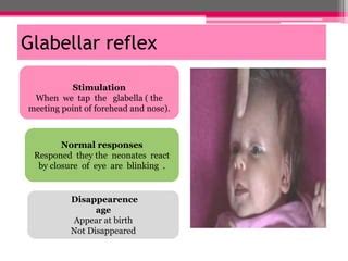 New born reflexes | PPT