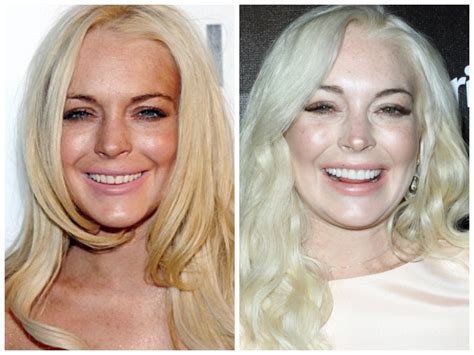 Celebrities with Veneers | My Porcelain Veneers