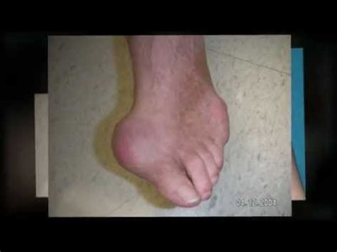 The 5-Second Trick For Symptoms of Gout in Ankle | Gout in Ankle