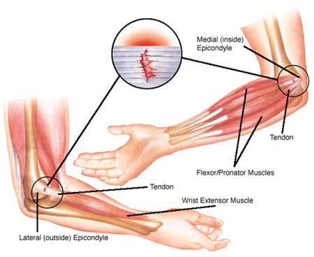 Inner or Outer Elbow Pain From Weight Lifting (17 Ways To Fix It)